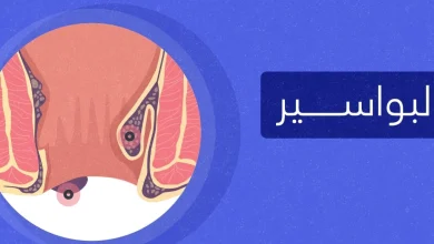 معالجة البواسير بالمنزل