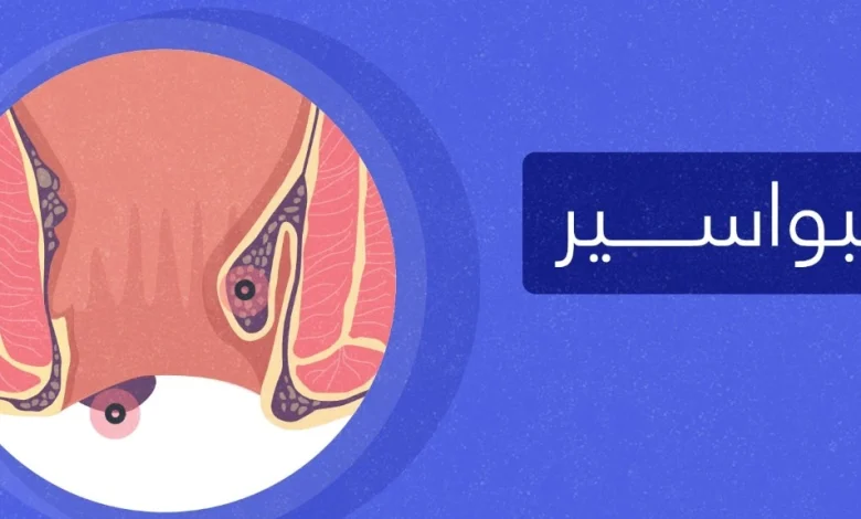 معالجة البواسير بالمنزل