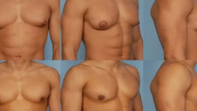 مشكلة التثدي للرجال