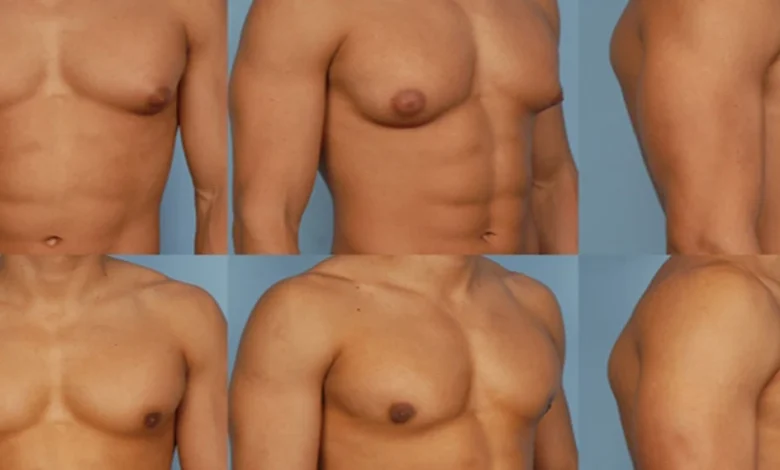 مشكلة التثدي للرجال