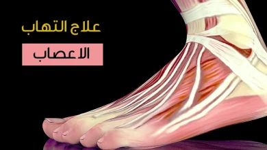 علاج التهاب الأعصاب و أنواع الخلايا العصبية