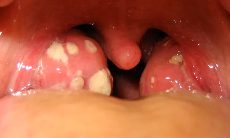 علاج التهاب اللوز بطرق صحيحه ووصفات منزلية بسيطه