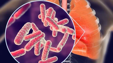 ما هو السل وطرق علاجه