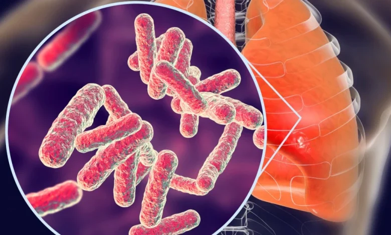 ما هو السل وطرق علاجه