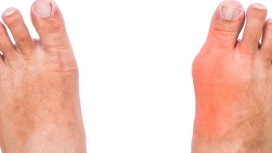 تشخيص مرض النقرس أسبابه وعلاجه