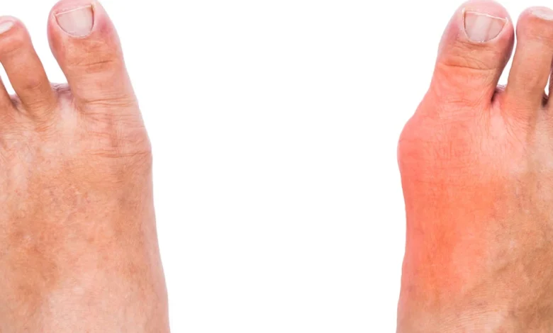 تشخيص مرض النقرس أسبابه وعلاجه