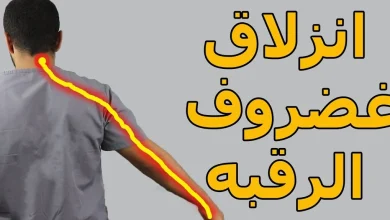 انزلاق غضروف الرقبة