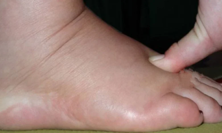 تقليل تورم القدمين للحامل في المنزل