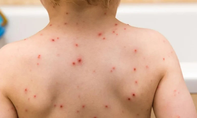 أهم أسباب جدري الماء وطرق علاجة