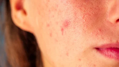 علاج حب الشباب وطرق الوقاية وأسباب ظهورة