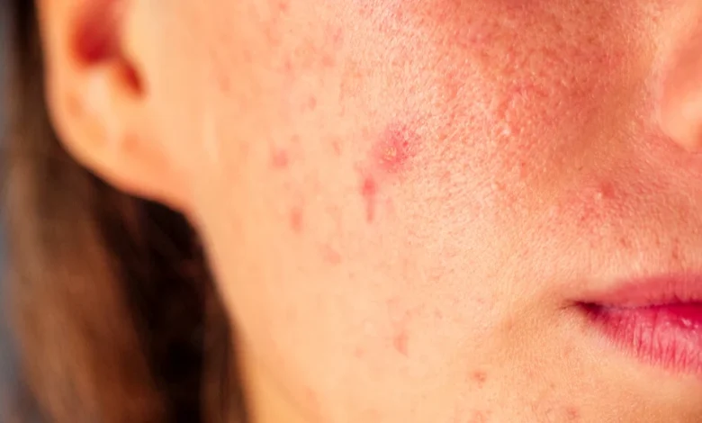 علاج حب الشباب وطرق الوقاية وأسباب ظهورة