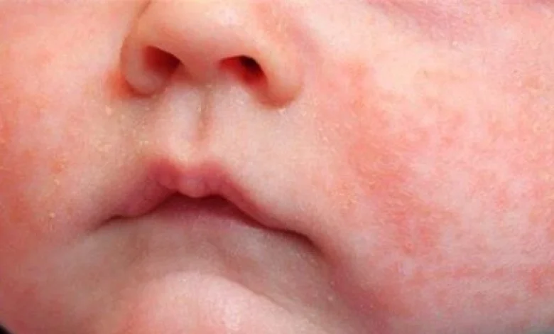 علاج حمو النيل وطرق الوقاية للأطفال والشباب