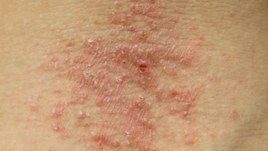 تشخيص الاكزيما | الأسباب والأعراض والعلاج والوقاية