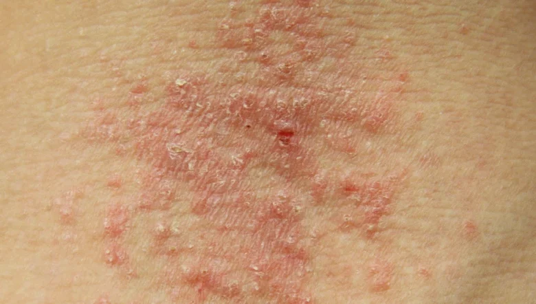 تشخيص الاكزيما | الأسباب والأعراض والعلاج والوقاية