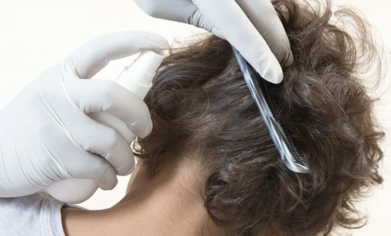 علاج القمل والصيبان في شعر الرأس والإبط