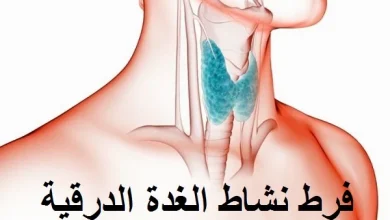 فرط نشاط الغده الدرقية
