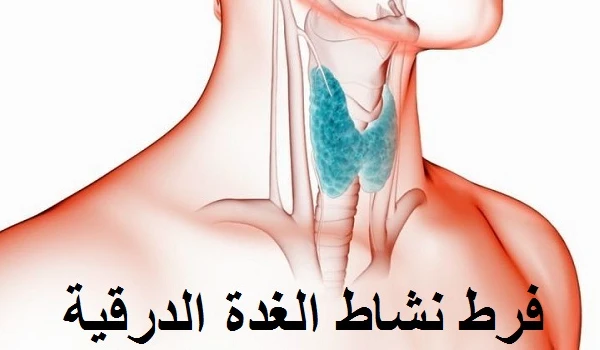 فرط نشاط الغده الدرقية