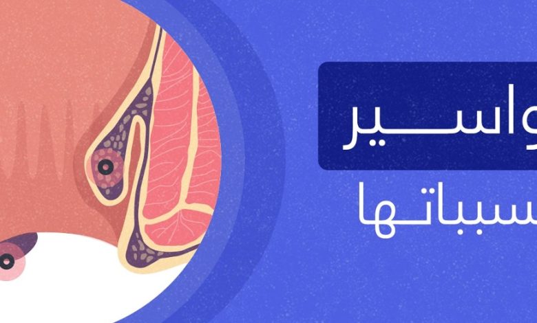 انواع البواسير والعوامل المسببة والعلاجات الدوائية والجراحية