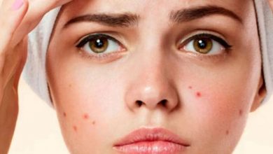 علاج لحب الشباب و الرؤوس السوداء