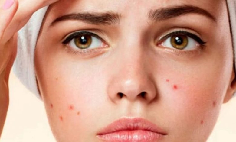 علاج لحب الشباب و الرؤوس السوداء