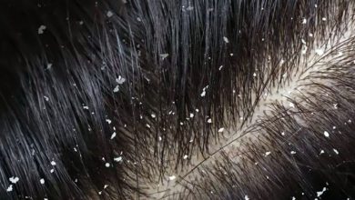 قشرة الشعر أسبابها وطرق التعامل معها