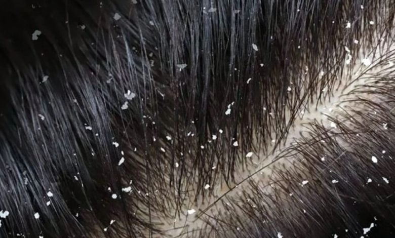 قشرة الشعر أسبابها وطرق التعامل معها