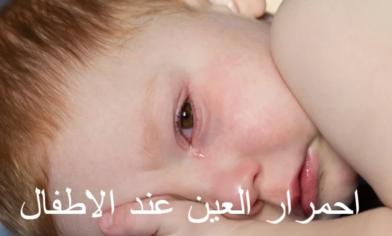 احمرار العين عند الأطفال و 9 طرق للوقاية