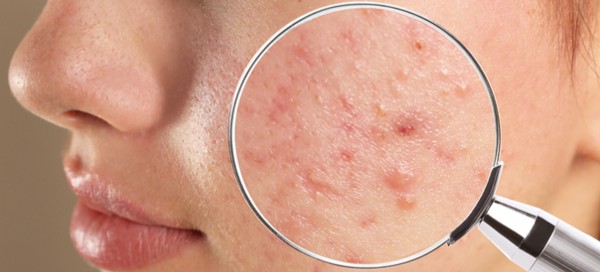 حب الشباب و الرؤوس السوداء وأفضل الوصفات العلاجية