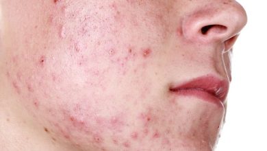 حب الشباب و الرؤوس السوداء وأفضل الوصفات العلاجية