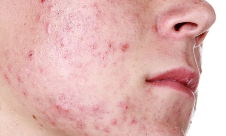 حب الشباب و الرؤوس السوداء وأفضل الوصفات العلاجية