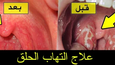 التهاب الحلق