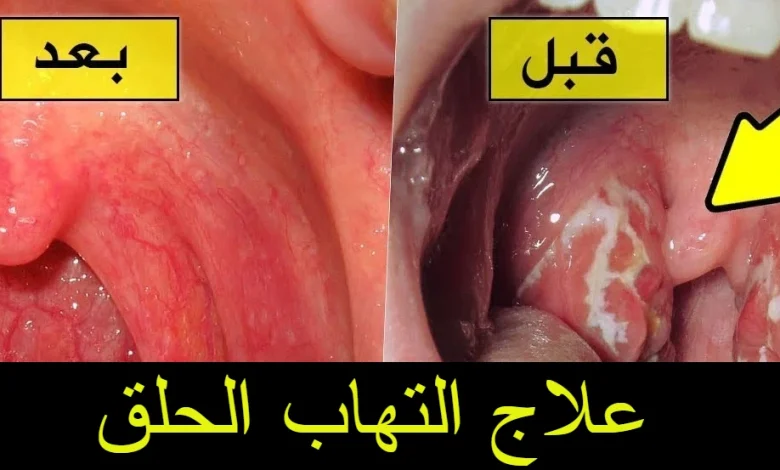 التهاب الحلق