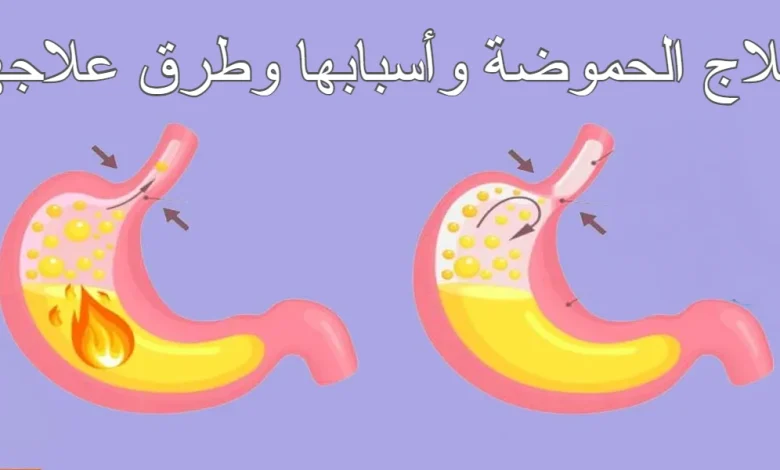 أسباب وعلاج الحموضة في المنزل