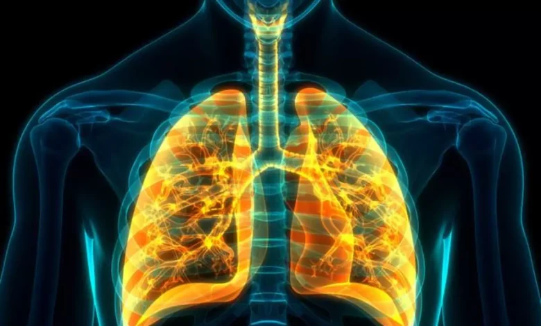 إلتهاب القصبات الحاد