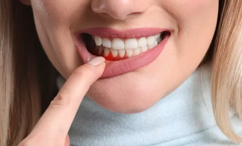 أمراض اللثة