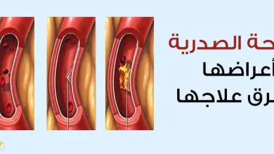 الذبحة الصدرية