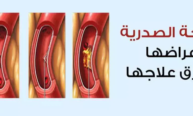 الذبحة الصدرية