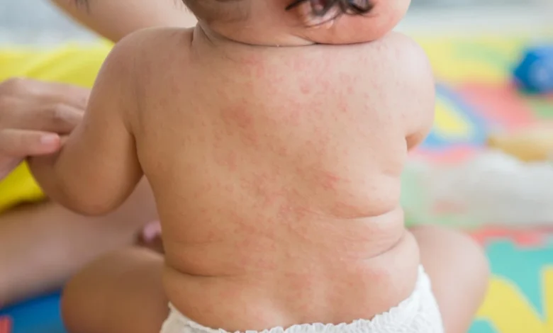 مرض الحصبة الألمانية