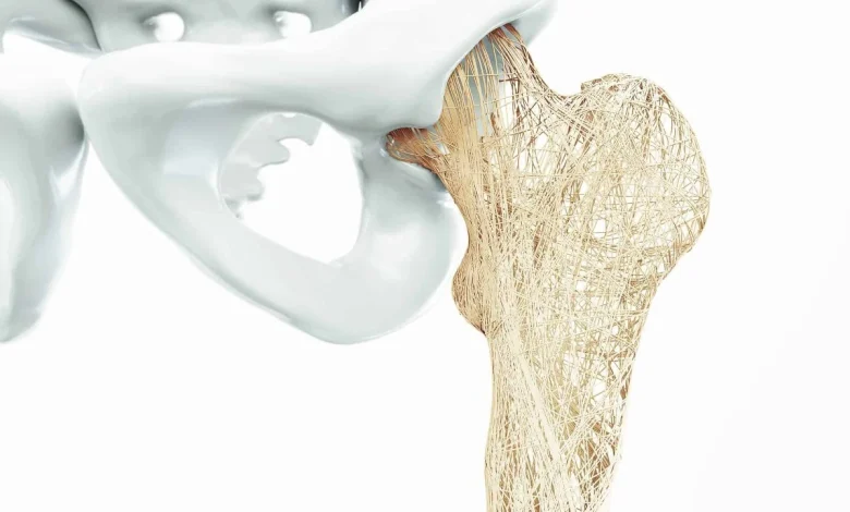 مرض هشاشة العظام