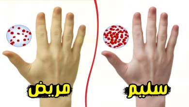 فقر الدم بسبب نقص الحديد