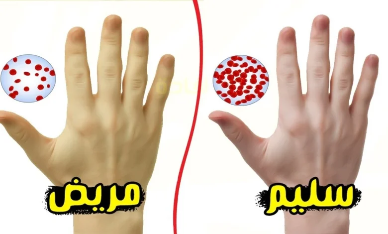 فقر الدم بسبب نقص الحديد