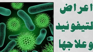 مرض حمى التيفوئيد