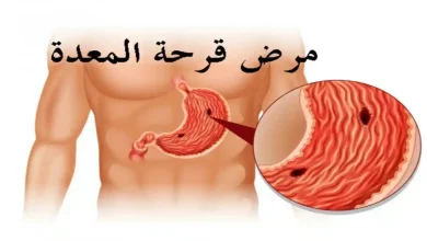 مرض قرحة المعدة