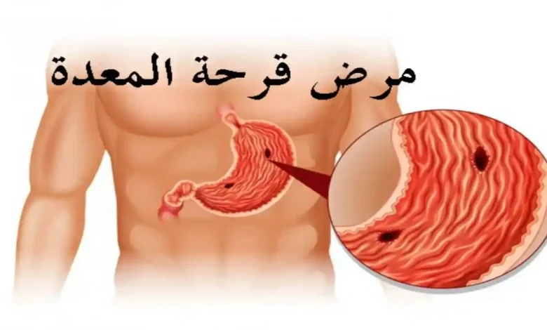 مرض قرحة المعدة