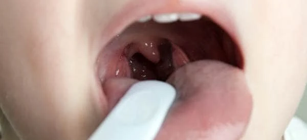 مرض إلتهاب الحنجرة