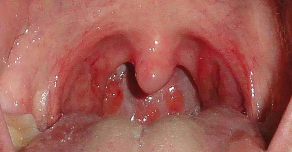 مرض إلتهاب الحنجرة