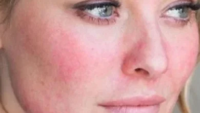 مرض الذئبة الحمراء