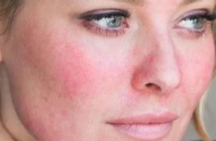 مرض الذئبة الحمراء