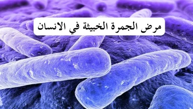 مرض الجمرة الخبيثة