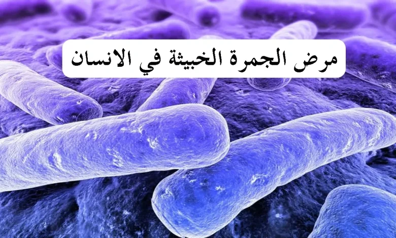 مرض الجمرة الخبيثة